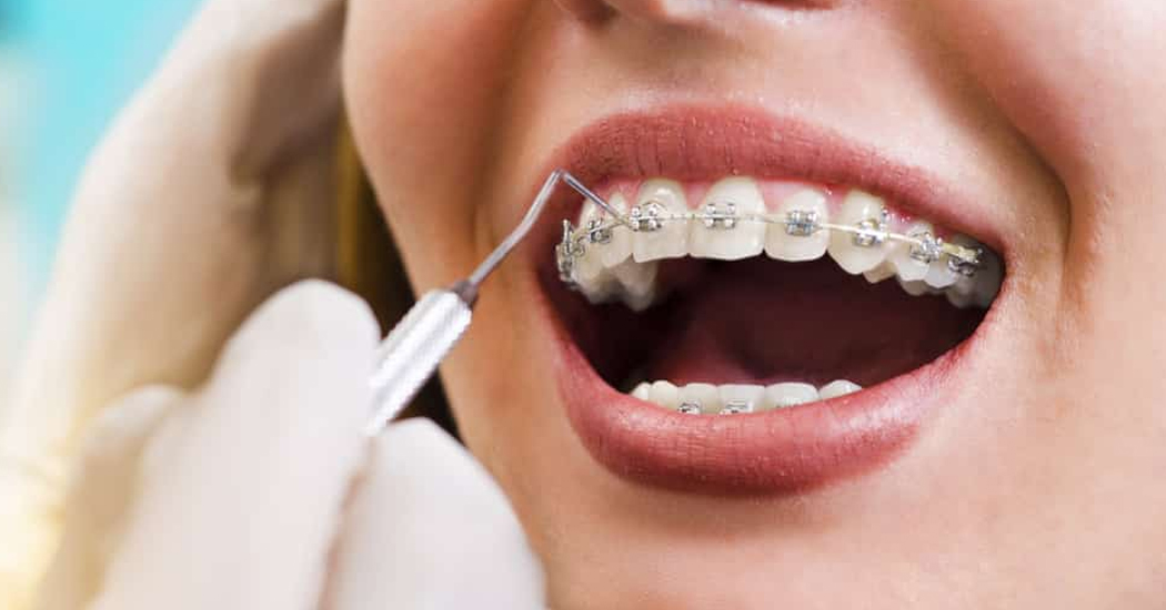 Teeth Alignment